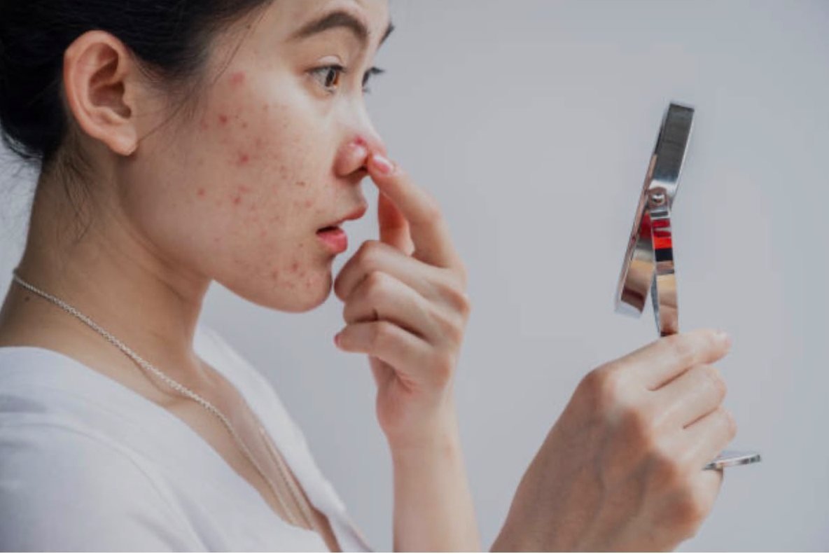 Woman checking acne on her cheek in a hand mirror
