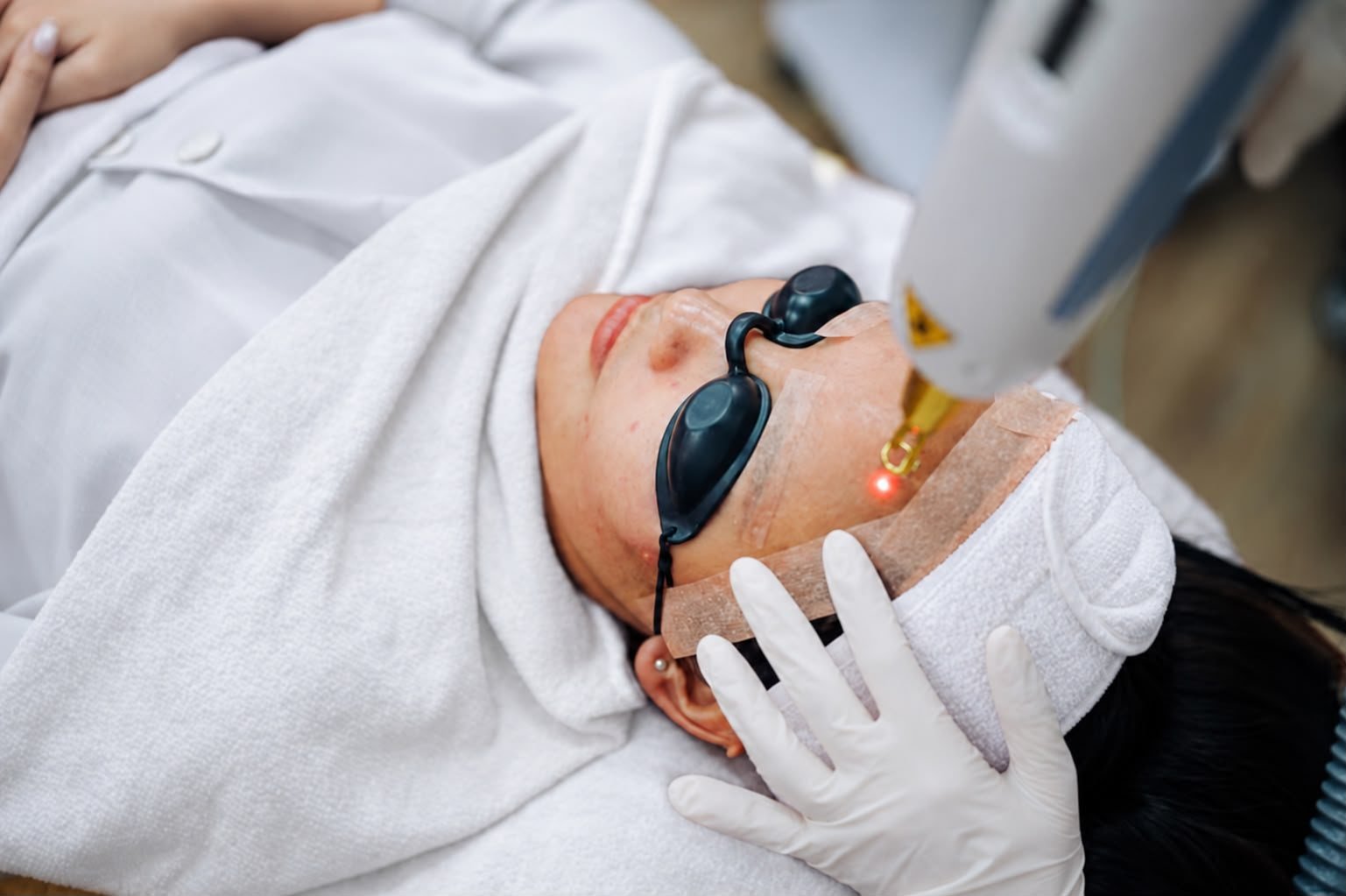 Patient wearing protective eye shields during a laser skin treatment